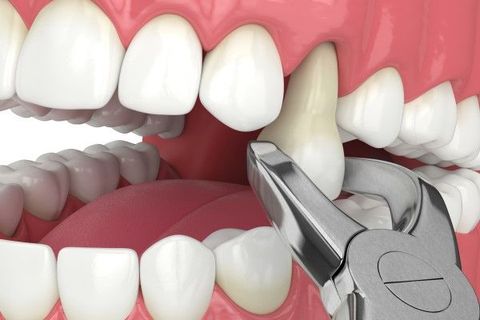 Tooth Extraction Recovery Tips for Faster Healing and Better Comfort